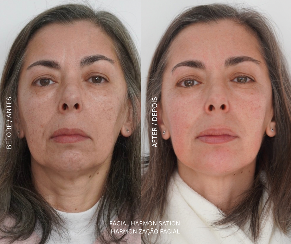 Injetáveis de Preenchimento Dérmico treatment at AD Lisbon clinic